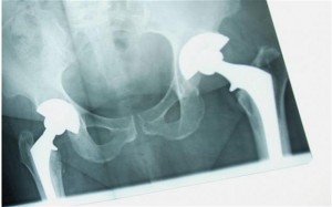 Macon Hip Replacement
